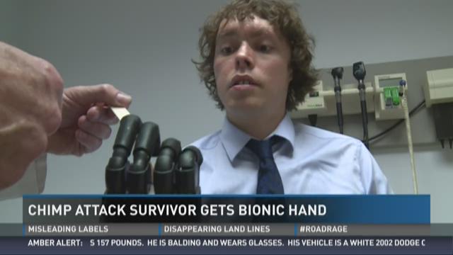 ksdk.com | Man attacked by chimps gets bionic hand